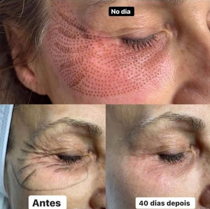 Jato de Plasma - Antes e Depois