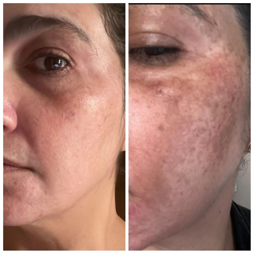 Tratamento de Melasma  - Antes e Depois