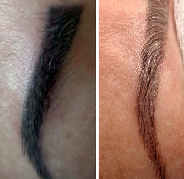 Despigmentação de sombrancelhas a laser - Antes e Depois