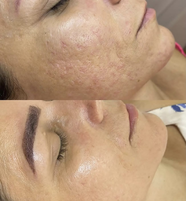 Peeling de Hollywood / Black Peel - Antes e Depois