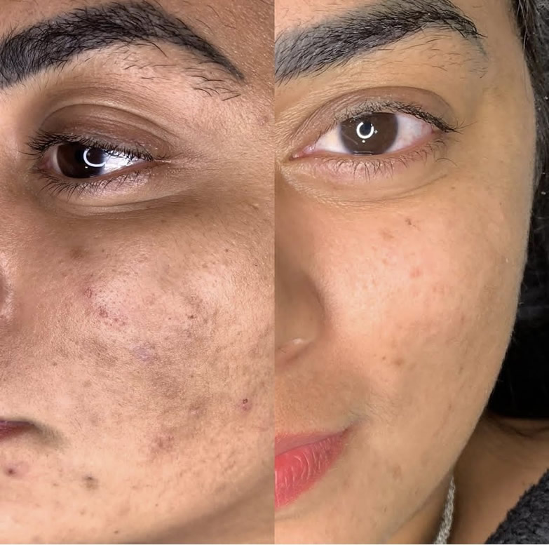 Peeling de Hollywood / Black Peel - Antes e Depois