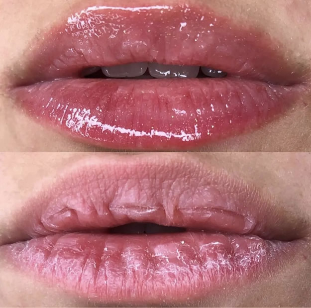 Hidragloss - Antes e Depois
