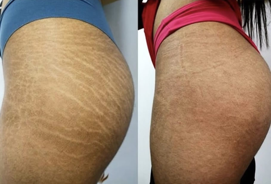 Tratamento de estrias - Antes e Depois